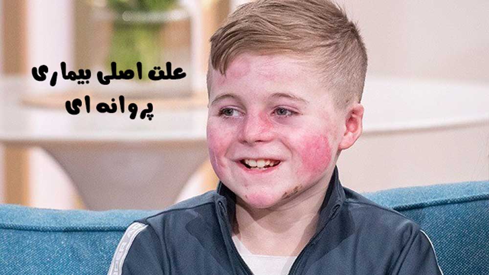 علت اصلی بیماری پروانه ای